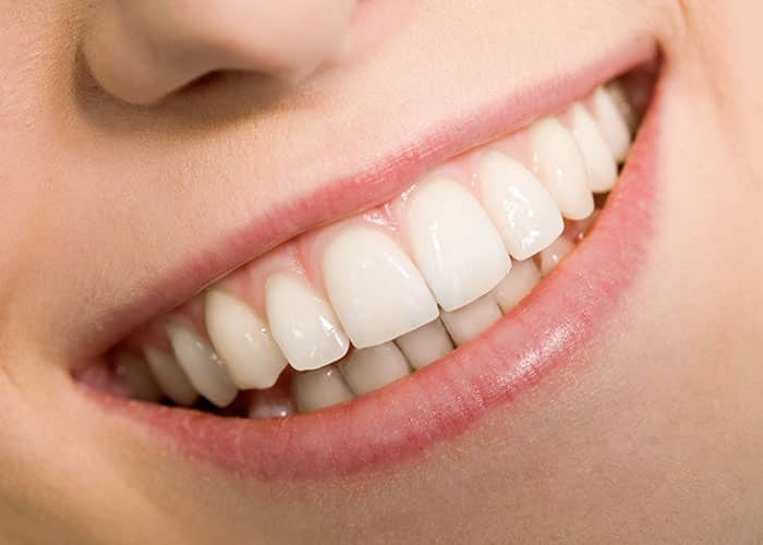 On Average, How Long Do Dental Veneers Last?
