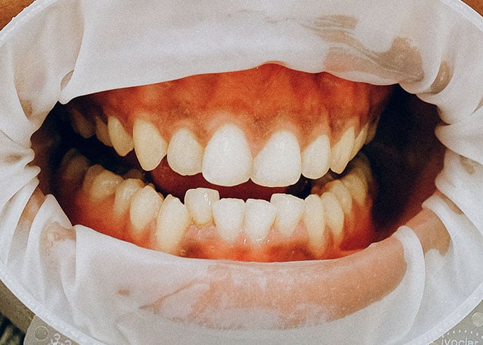 Gum Disease in America - A Serious Preventable Problem