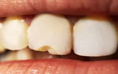 What Problems Can Dental Veneers Fix?