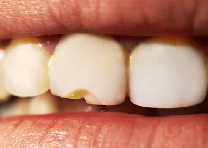 What Problems Can Dental Veneers Fix?