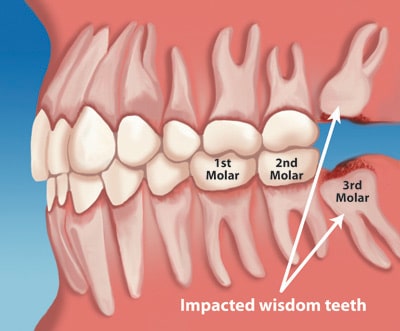 need your wisdom teeth removed