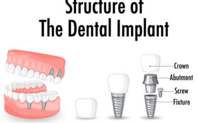 What Are Dental Implants?