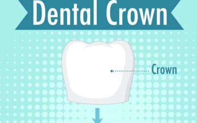 The Oral Health Benefits of Dental Crowns