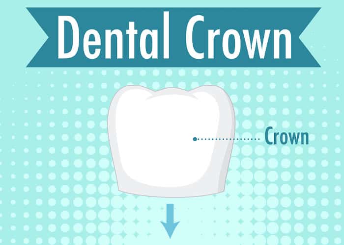 The Oral Health Benefits of Dental Crowns