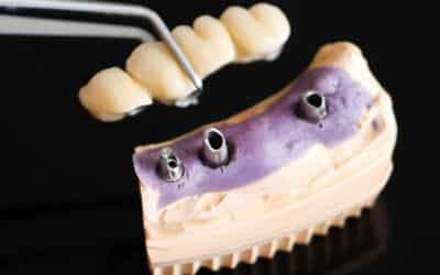 What Are Dental Bridges & How Do They Work?