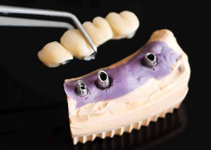 What Are Dental Bridges & How Do They Work?