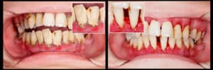 Before and After oral signs of gum disease treatment