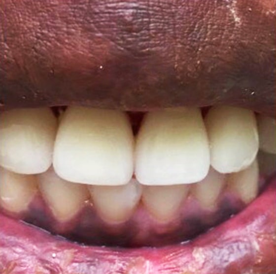 patient's teeth after