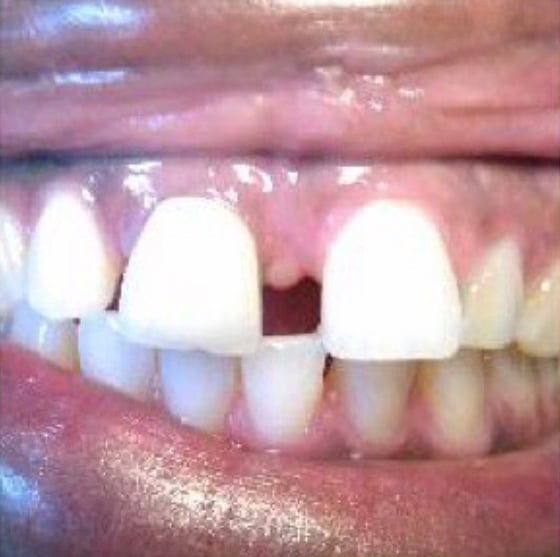 patient's teeth before
