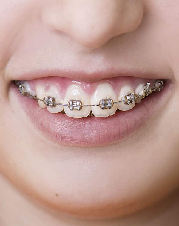 City Dental Center Services Braces for Kids and Braces for Adults