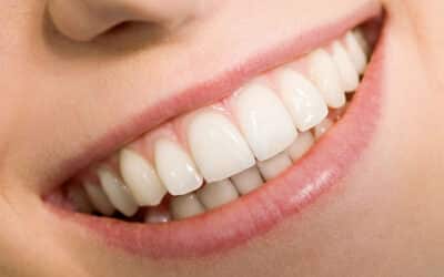 On Average, How Long Do Dental Veneers Last?