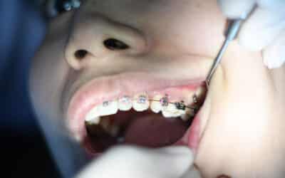 Removing Teeth for Braces Facial Defects Might Benefit Your Oral Health