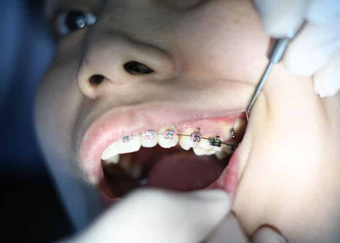 Removing Teeth for Braces Facial Defects